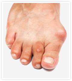 gout-on-foot